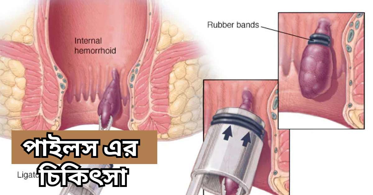 পাইলস এর চিকিৎসা piels er chikitsha